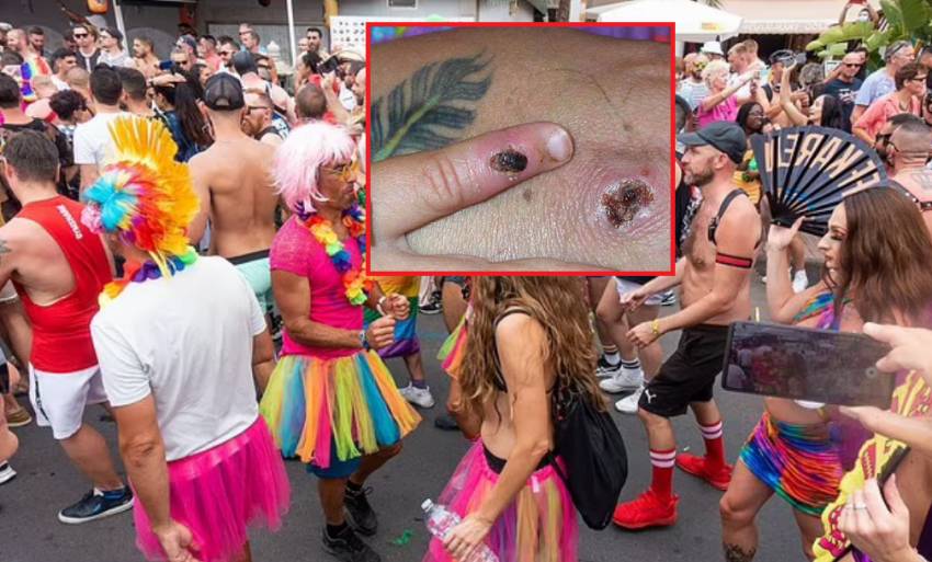 Festivalul Mândriei Homosexuale din Insulele Canare, focar de variola maimuțelor